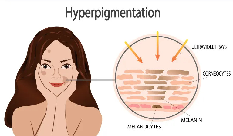 How to Get Rid of Hyperpigmentation Around Mouth?