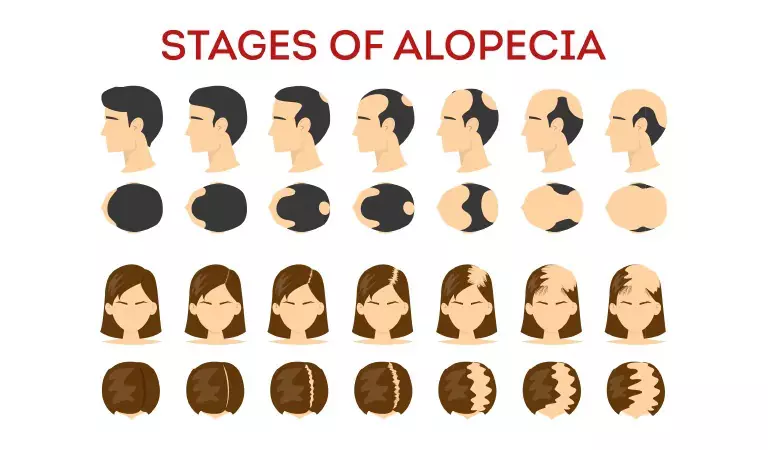 How to stop alopecia areata from spreading naturally