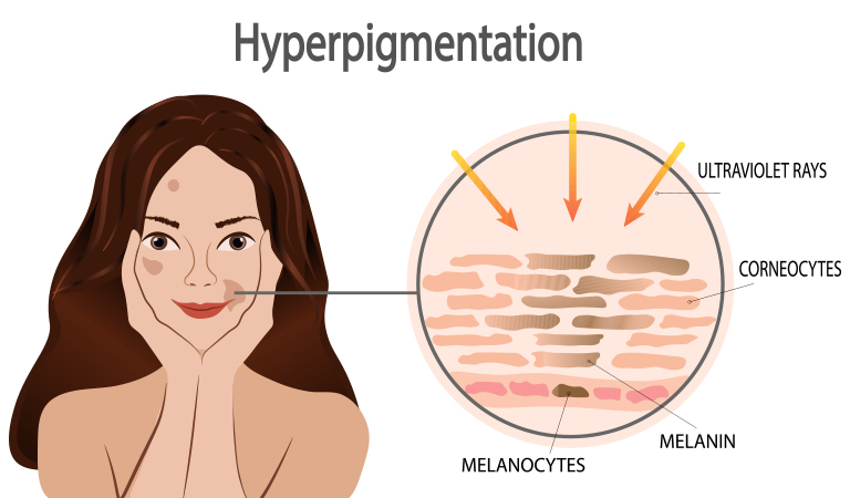 skin_pigmentation