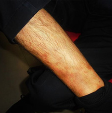 Psoriasisout-after-outcome