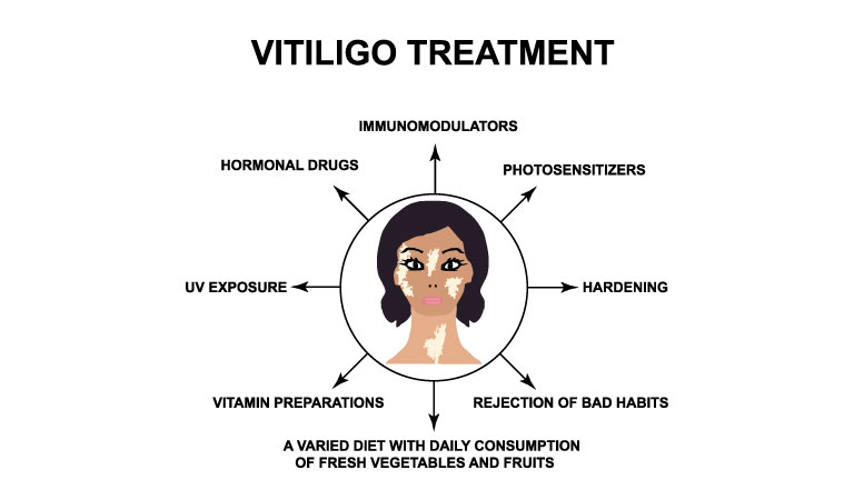 Vitiligo Treatment