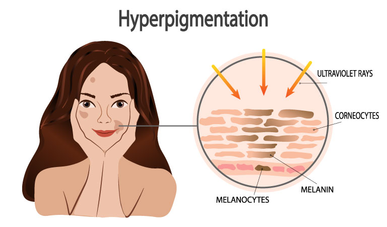 How to manage hyperpigmentation in the summer