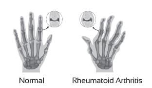 arthirities-thumb-1