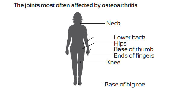 osteoarthritis-thumb-1