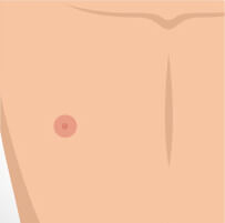 seborrhoeic-thumb-6