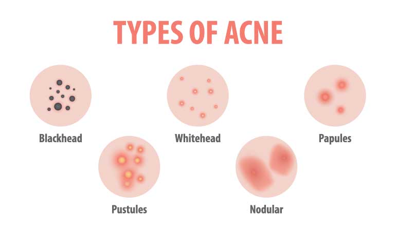 Easy Remedies For Acne That Really Work