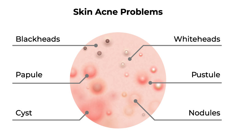 How can one get rid of acne as quickly as possible?