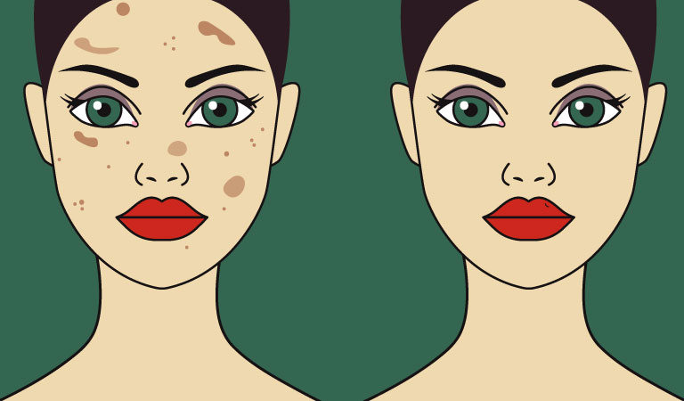 Everything You Need to Know About Hyper-Pigmentation Treatment