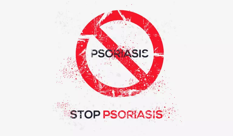 Can Scalp Psoriasis Cause Hair Loss?