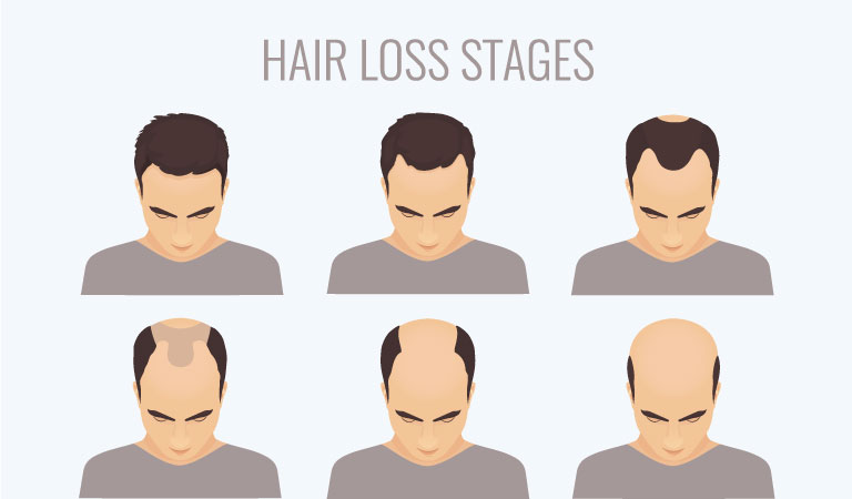 7 Best Men's HairLoss Treatments 2020