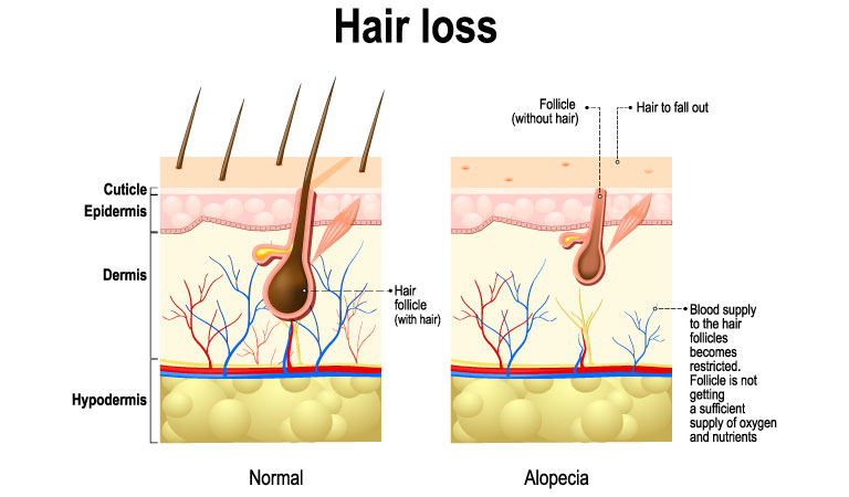 How to Mentally Overcome Alopecia Areata?