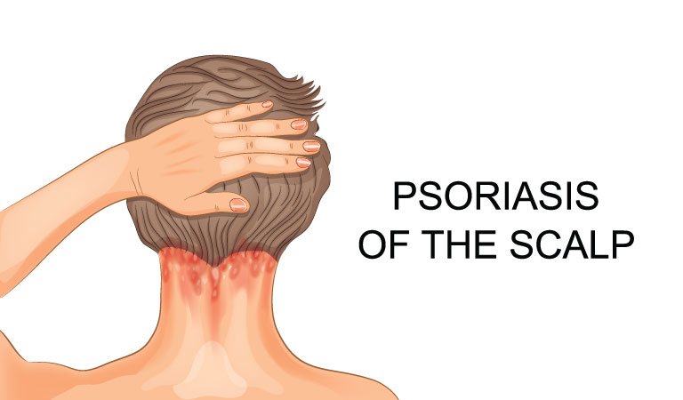 How Does One Reduce Hair Psoriasis?