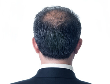 Most common hair loss condition characterized by a typical pattern of receding hairline at the temples and hair thinning on the crown.