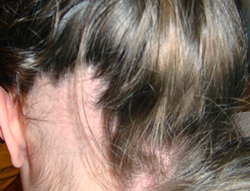 Condition in which the hair does not fall out but is pulled out by the patient in response to some emotional stress.