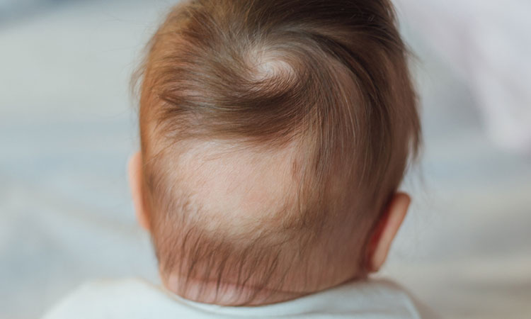 MY CHILD HAS HAIR LOSS IN PATCHES. CAN IT BE TREATED