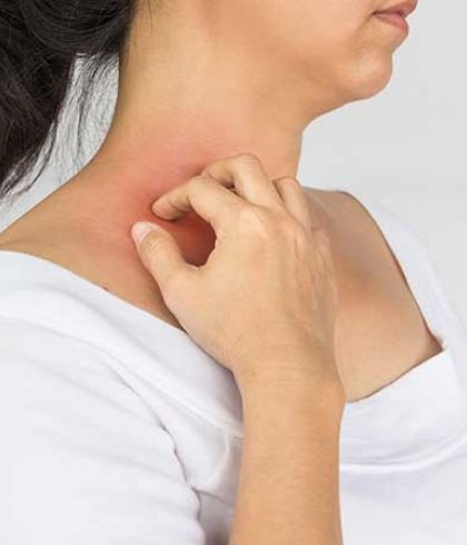 PSORIASIS