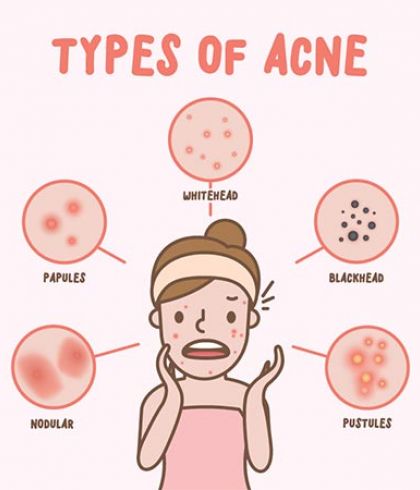 homeopathic-medicine-for-acne_2