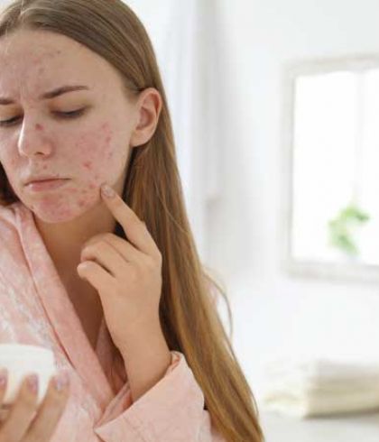 Easy Remedies For Acne That Really Work