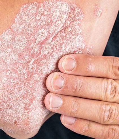 Psoriasis can be treated by Homeopathy