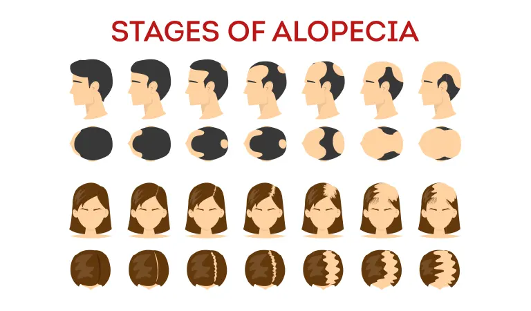 Stages of Alopecia