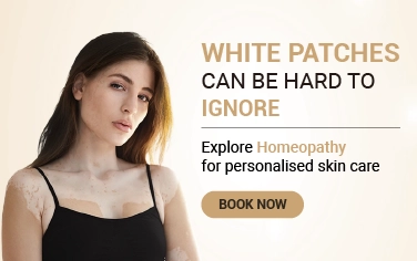Vitiligo Treatment