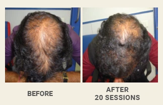 Homeopathy Hair Loss Treatment | Hair Fall Solution | Dr Batra's™ Homeopathy Hair Loss Treatment | Hair Fall Solution | Dr Batra's™