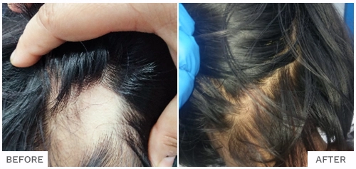 Hair Fall Treatment