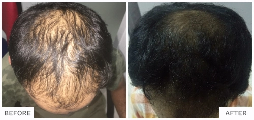 Hair Falling Treatment