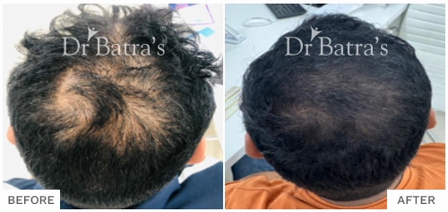 Hair Loss