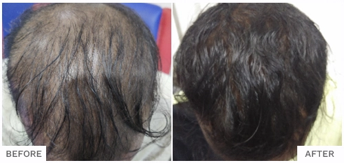 Hair Loss Treatment