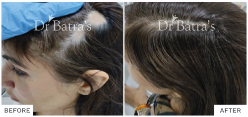 Alopecia Areata