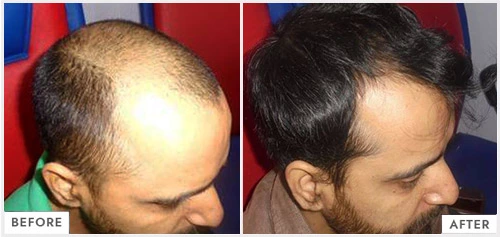 Hair Fall Treatment