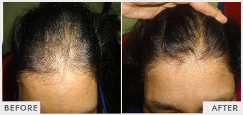 Female Hair Loss Treatment