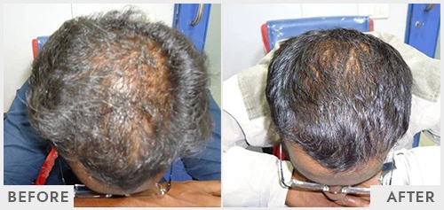 Hair Falling Treatment