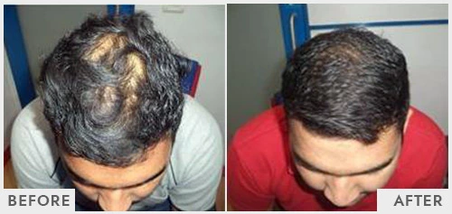 Hair Loss Treatment