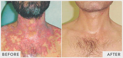 Eczema Treatment