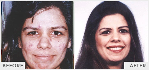 Skin Treatment