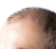Hair Fall Treatment - Dr Batras