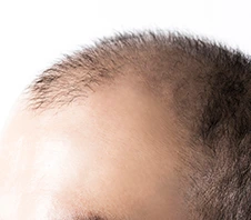 Hair Treatment, Hair Loss Treatment Homeopathy For Men & Women Hair Treatment, Hair Loss Treatment Homeopathy For Men & Women