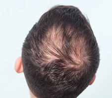 Hair Loss Treatment - Dr Batras