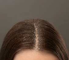 Best Dandruff Treatment - Dr Batras