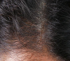 Hair Psoriasis Treatment - Dr Batras