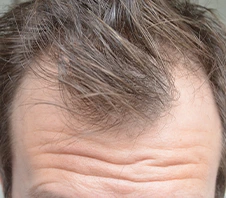 Hair Loss Treatment - Dr Batras