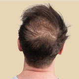 Baldness Treatment