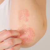 PSORIASIS TREATMENT