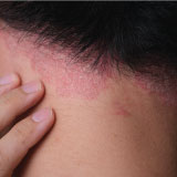 Scalp Psoriasis Treatment