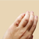 WARTS TREATMENT
